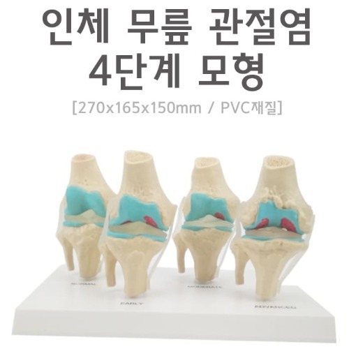 인체 무릎 관절염 4단계 모형