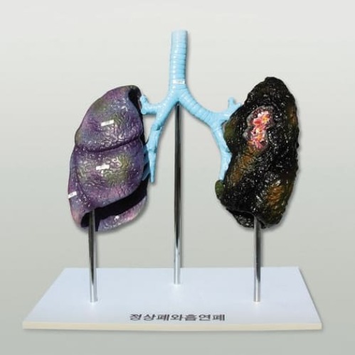 폐의 비교(정상폐와 흡연폐)